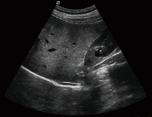 Kidney Cyst | VUE-MEDTECH